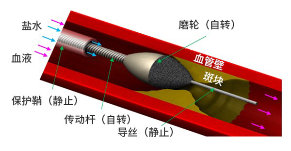 科研-医疗-动脉旋磨2-600.jpg